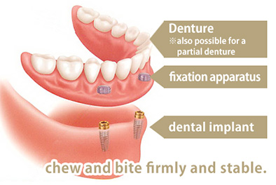 Dental implants supported Dentures