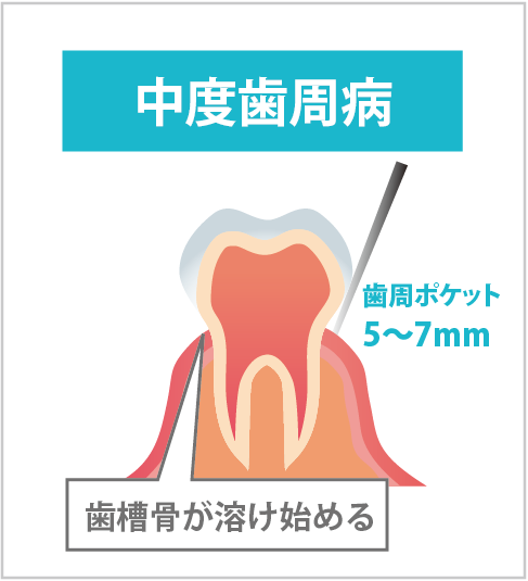 中度歯周病