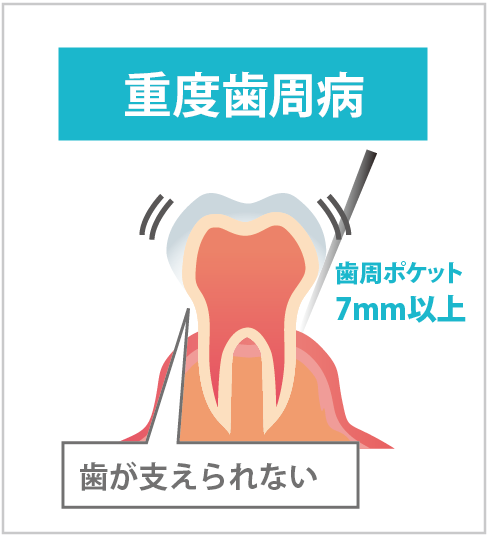 重度歯周病