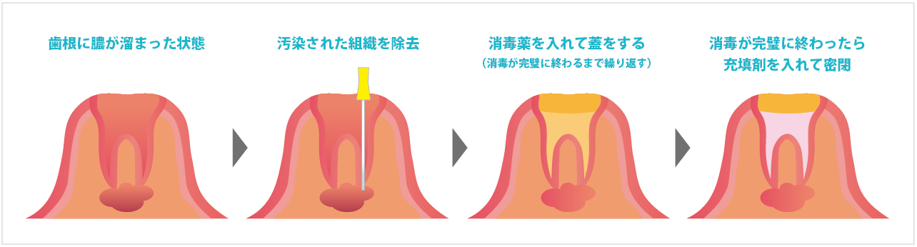 根管治療