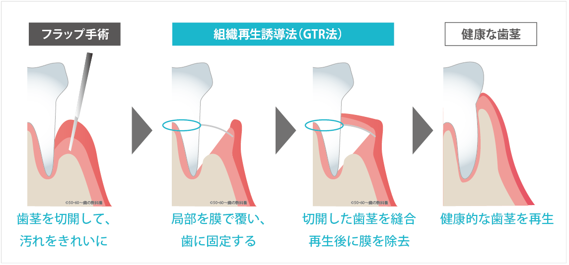 GTR法の説明