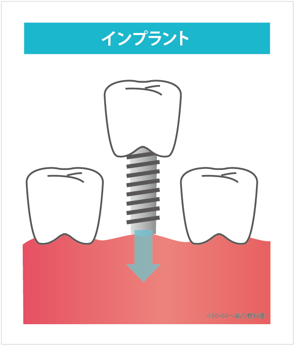 インプラントの説明図