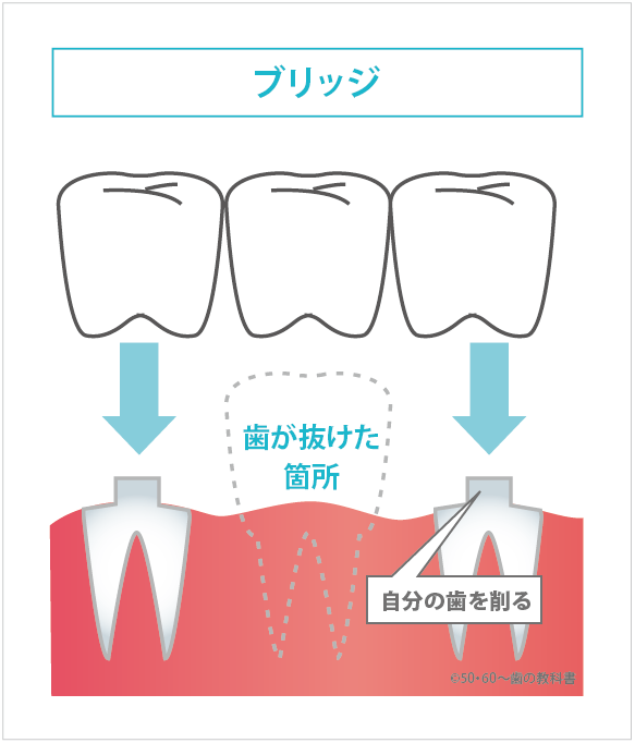 ブリッジの説明