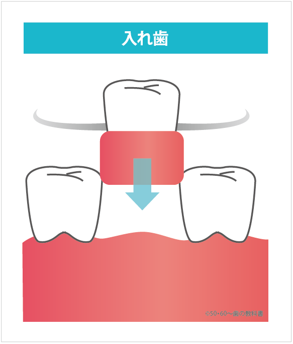 入れ歯の説明