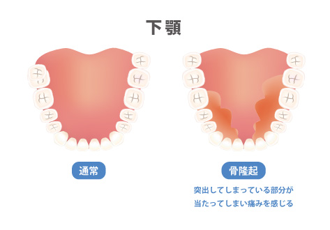 歯茎の粘膜が薄くなっている／骨隆起ができている