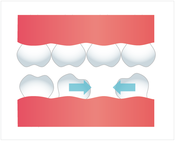 歯の傾斜の図