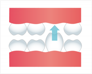 歯の挺出の図