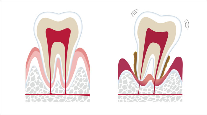 通常の歯と歯周病