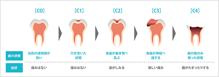 虫歯の進行イメージ