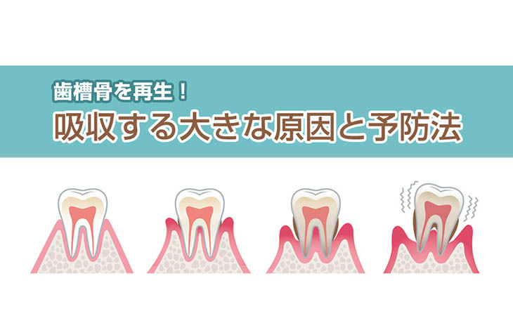 歯槽骨を再生！吸収する大きな原因と予防法