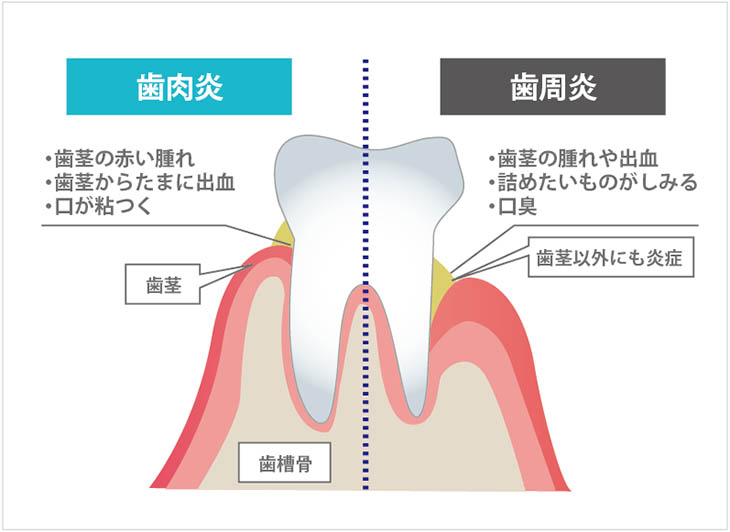 歯肉炎と歯周炎のイメージ図
