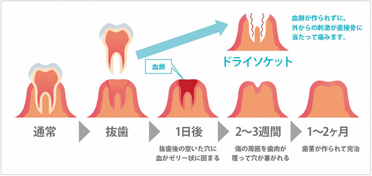 検出されない可能性が高いがん
