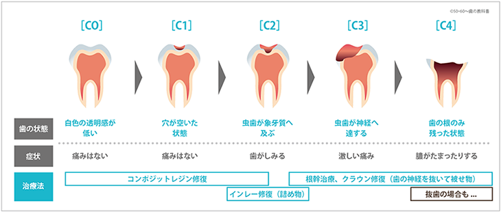 コンポジットレジンの修復適用範囲は小さな虫歯