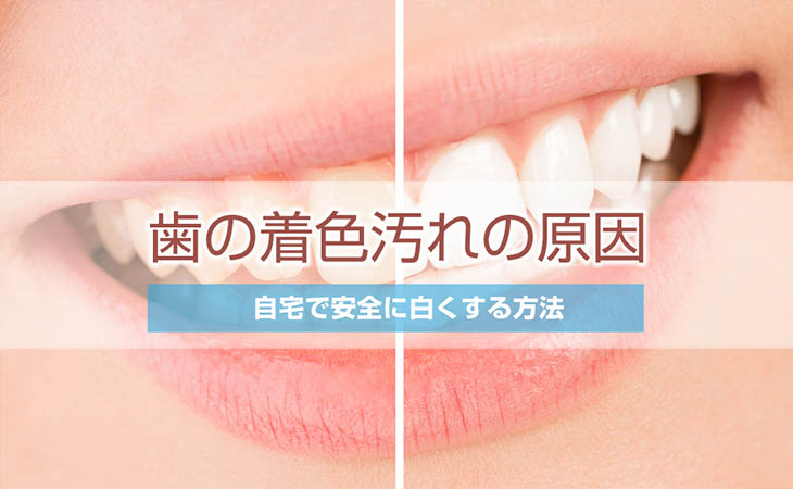 歯の着色汚れの原因と自宅で安全に白くする方法