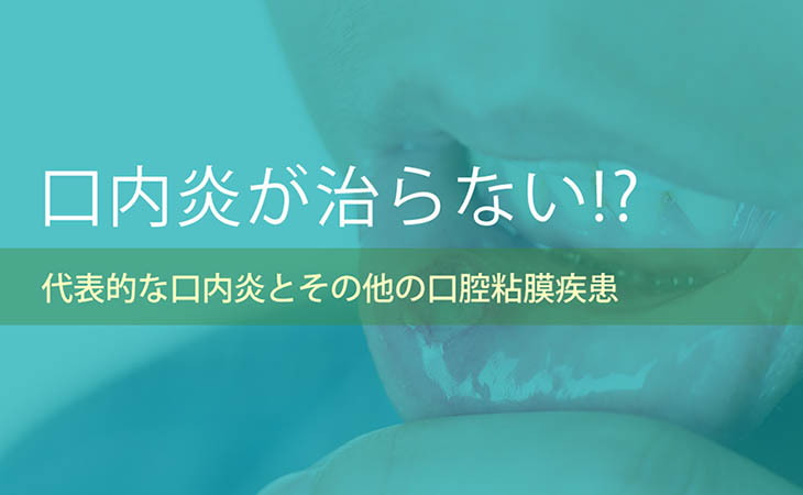 口内炎が治らない!?代表的な口内炎とその他の口腔粘膜疾患