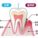 通常と歯周病の説明